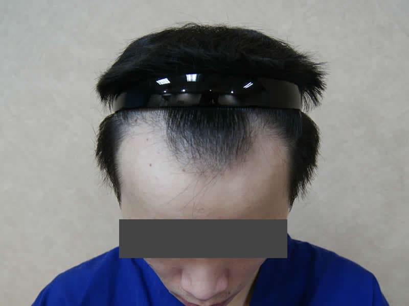 FUE 1,632 術後